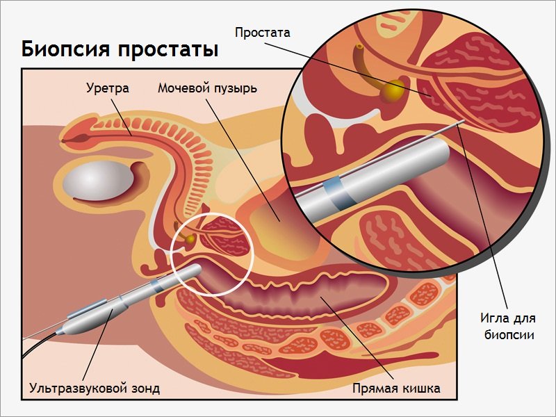 Biopsie prostata ergebnis dauer